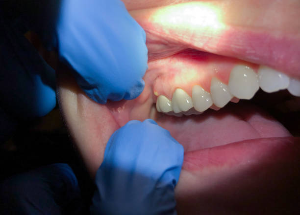 Best Emergency Tooth Extraction in Crab Orchard, WV